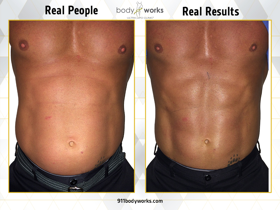 Bodyworks Ultra Lipo Clinic The New Alternative To Liposuction